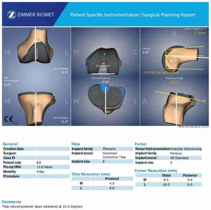 ROSA 3D preoperative surgical plan for robotic-assisted knee replacement