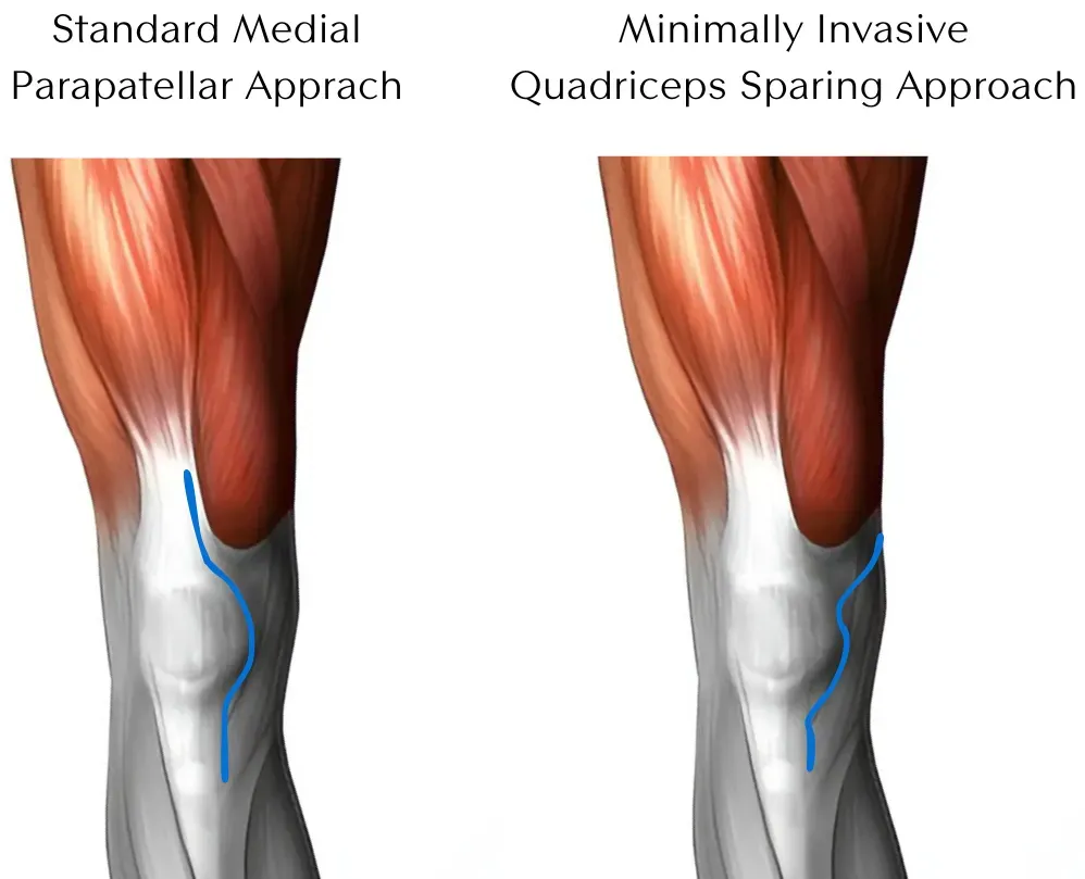 Subvastus muscle-sparing approach for knee replacement