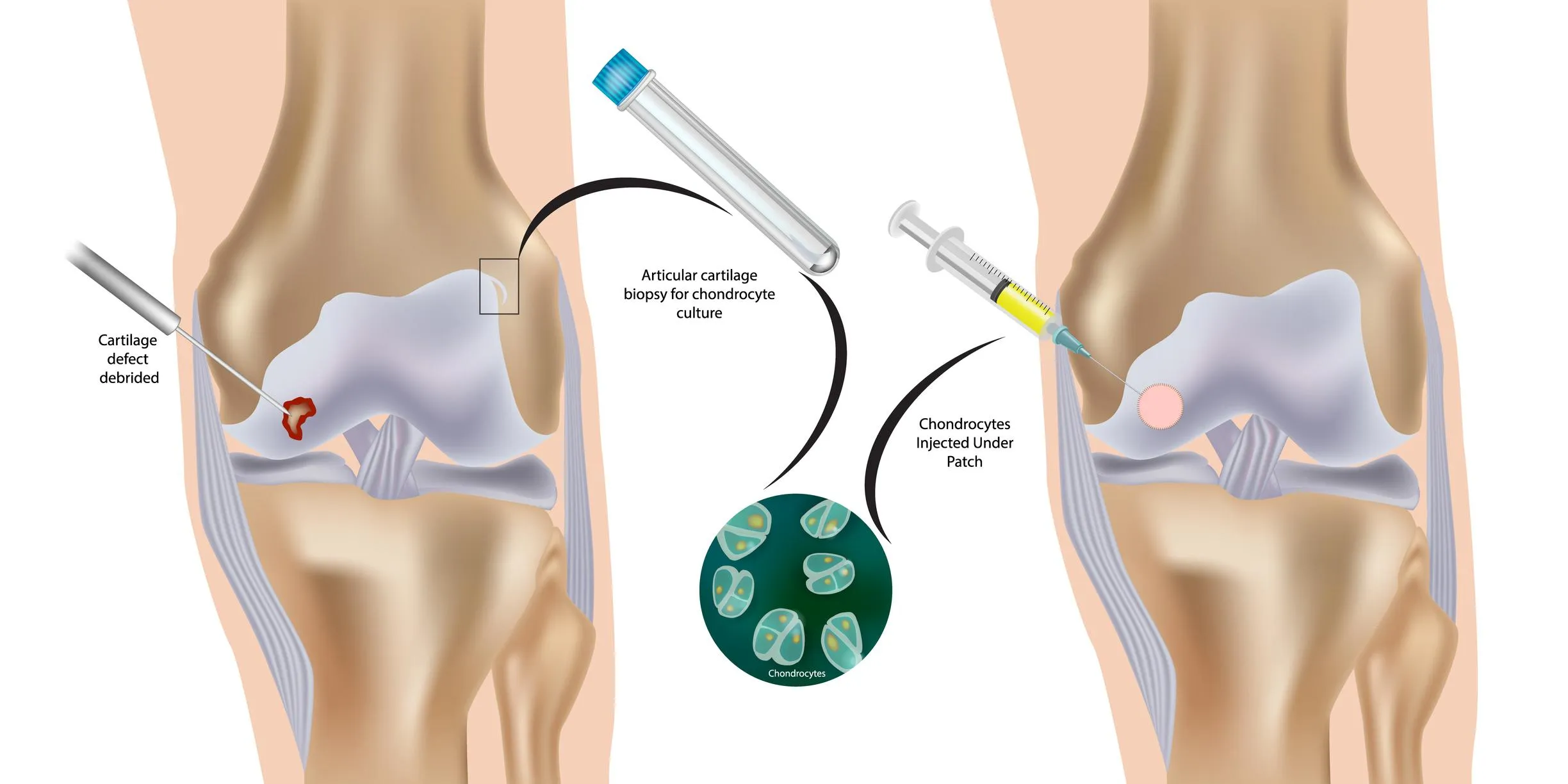 Three-step diagram of autologous chondrocyte implantation: cartilage biopsy, cell culturing, and implantation into the defect