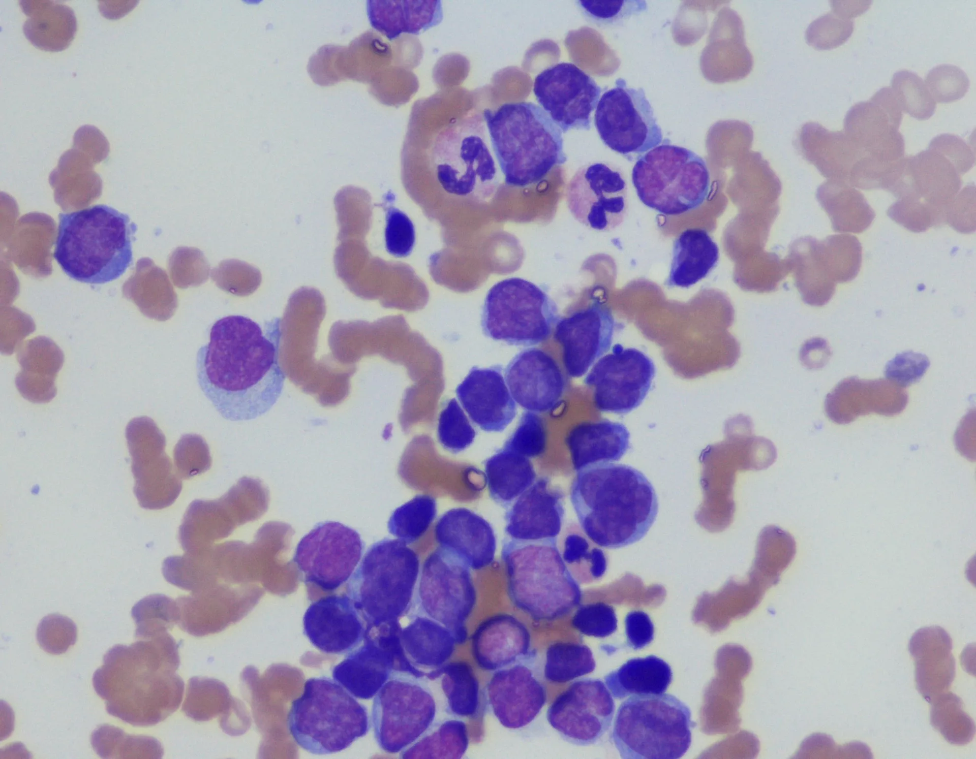 Stained bone marrow aspirate cells viewed under a microscope