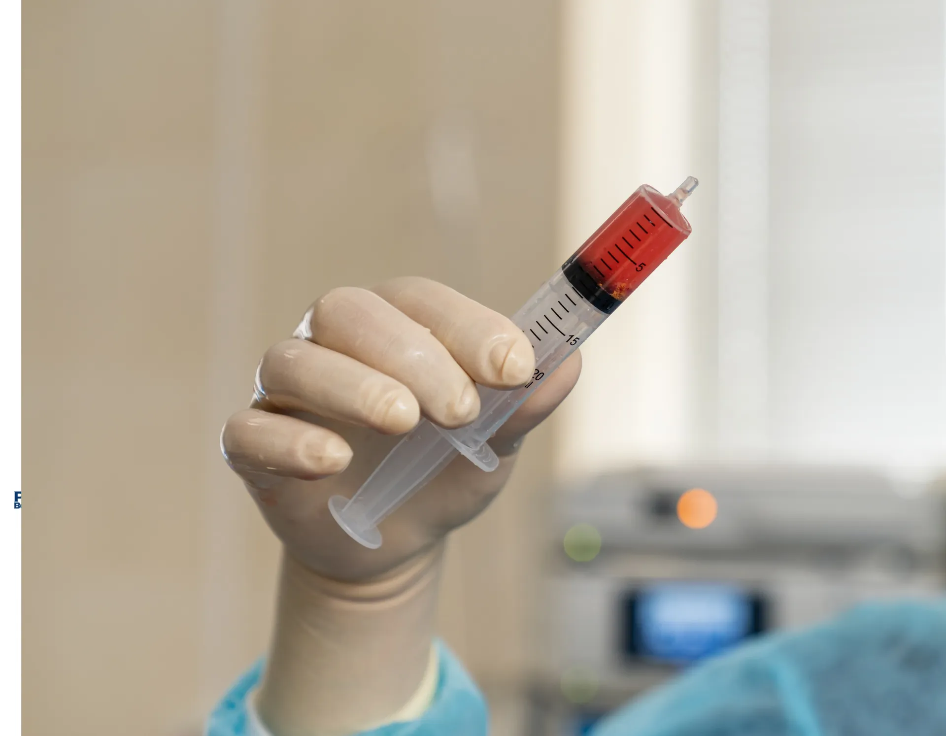 Gloved hand holding a syringe of layered bone marrow concentrate