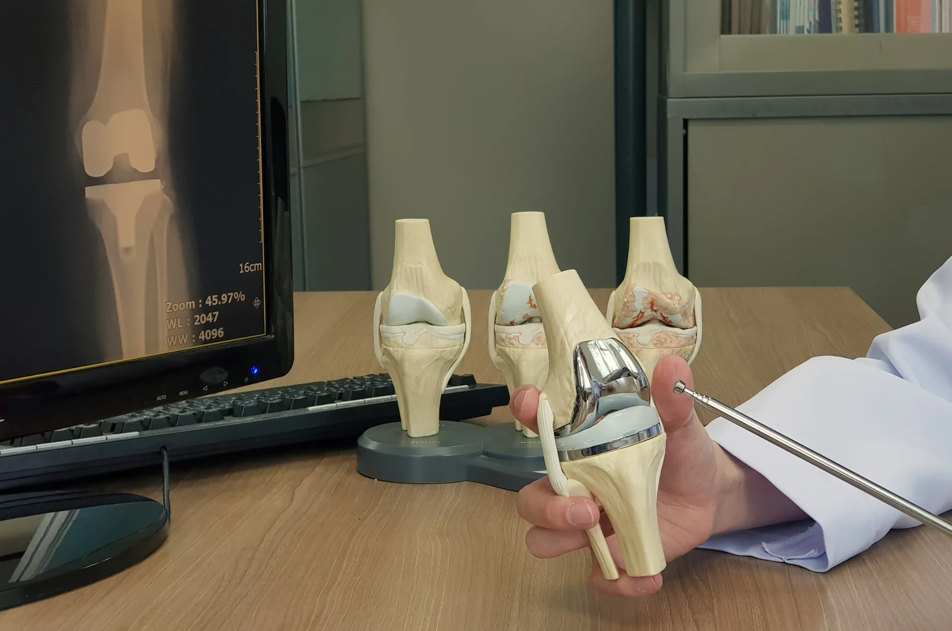 Hand holding a total knee implant model beside knee anatomy models and a knee X-ray on a monitor