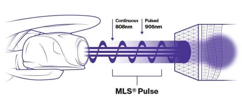 Diagram of the MLS pulse: a continuous 808 nm emission and a pulsed 905 nm emission delivered together