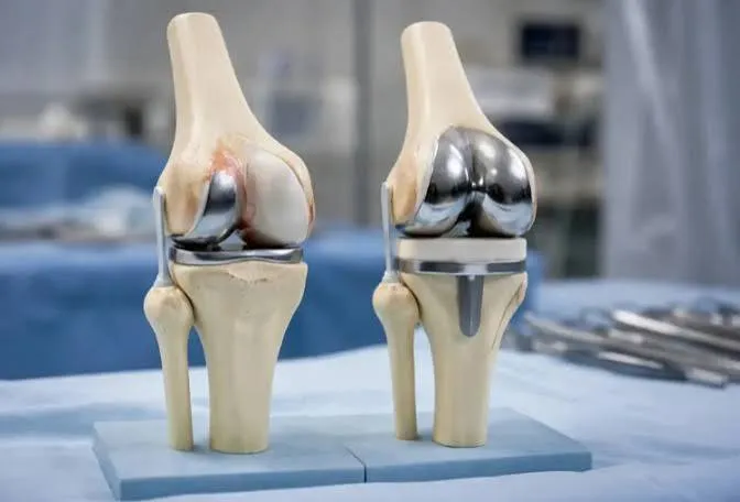Two knee models side by side: a partial (unicompartmental) knee replacement resurfacing only the inner compartment, next to a total knee replacement resurfacing the whole joint