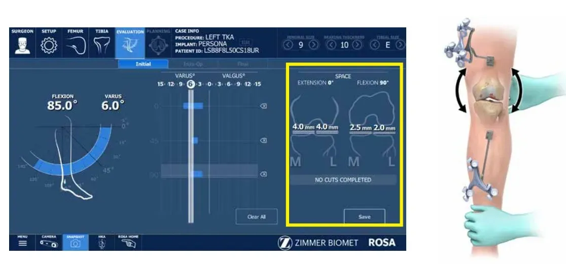 ROSA Knee software evaluation screen showing flexion, alignment, and soft-tissue balance measurements