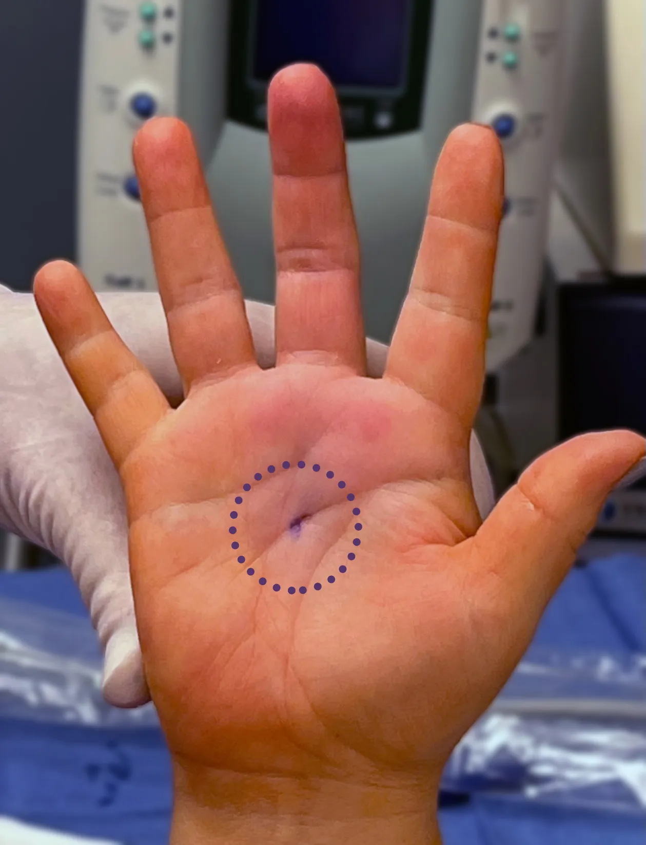 A palm with a small dotted circle marked at the base of a finger