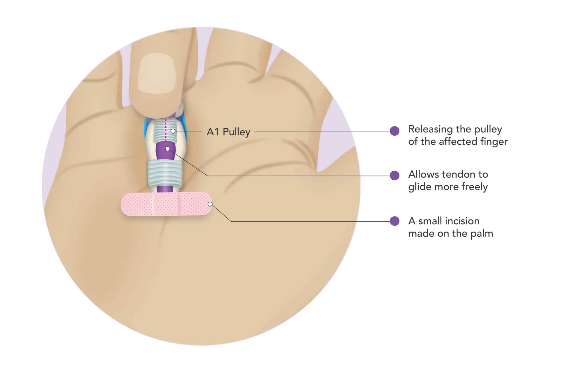 Labeled diagram of a trigger finger release, showing the pulley opened so the tendon can glide
