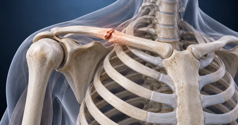 Broken Collarbone: When a Sling Is Enough and When Surgery Helps