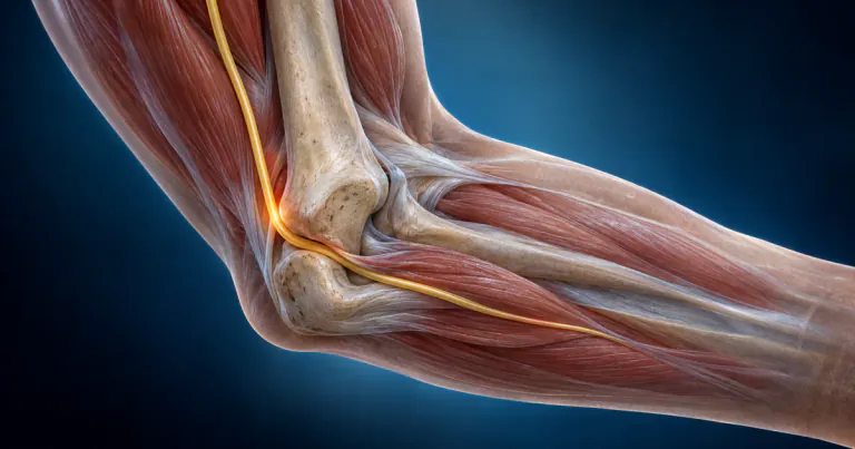 Cubital Tunnel Syndrome: Why the Ring and Small Fingers Go Numb and When Surgery Helps