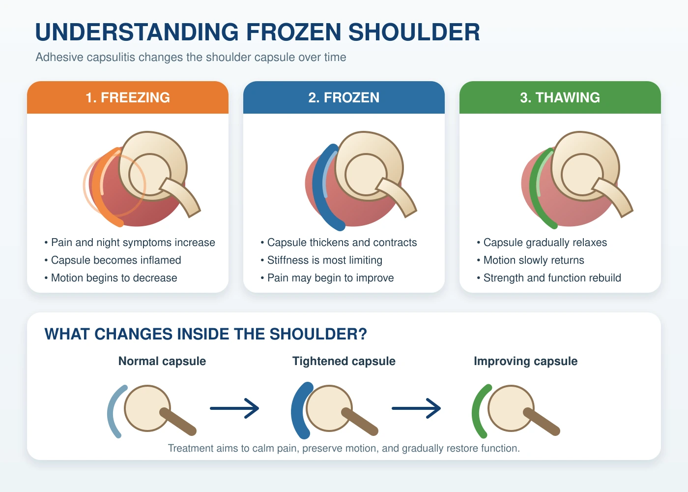 Understanding the freezing, frozen, and thawing stages of adhesive capsulitis, with a comparison of a normal, tightened, and improving shoulder capsule.
