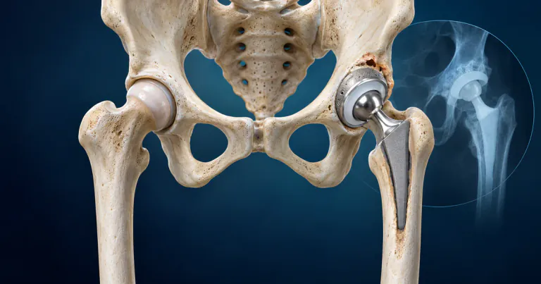 Hip Replacement Failure: Warning Signs, Testing, and When Revision Surgery Helps
