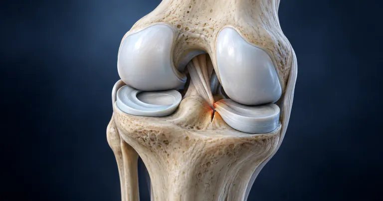 Meniscus Root Tear: Why It Can Cause Rapid Knee Arthritis and When Repair Helps