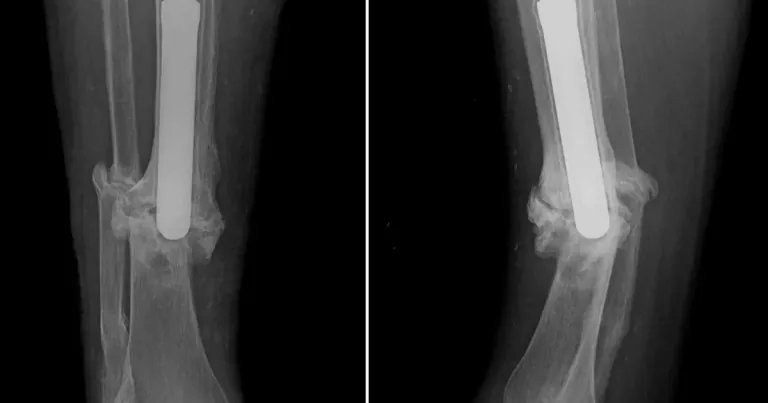 Fracture Not Healing? Understanding Delayed Union and Nonunion
