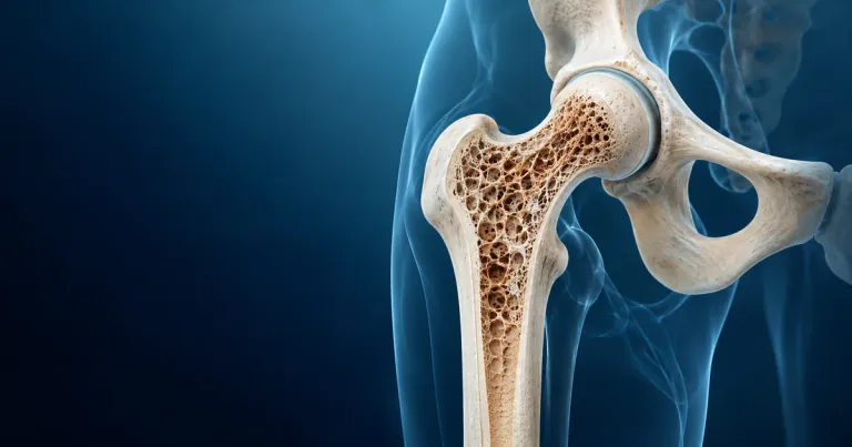 Osteoporosis Medication After a Fracture: How Prolia, Reclast, and Evenity Differ