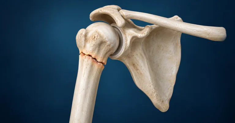 Proximal Humerus Fracture: When a Sling Is Enough and When Surgery Helps