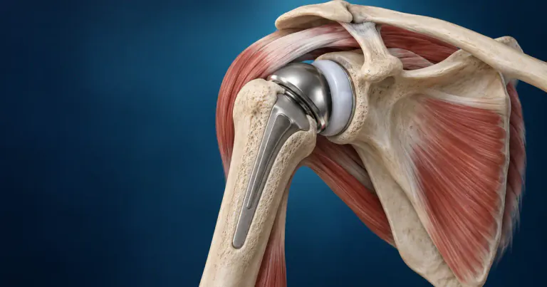 Shoulder Arthritis: When Is It Time for Shoulder Replacement?